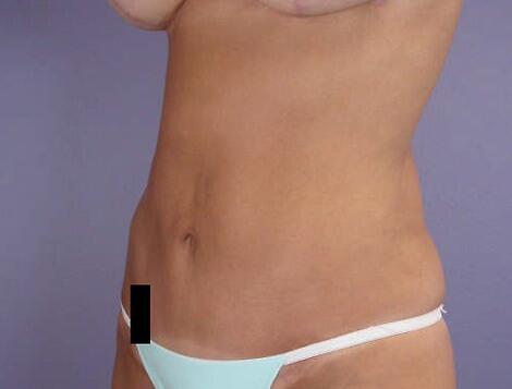 Liposuction Before & After Image