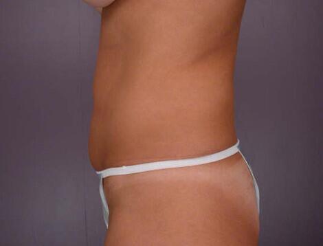 Liposuction Before & After Image