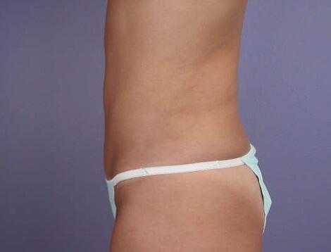 Liposuction Before & After Image