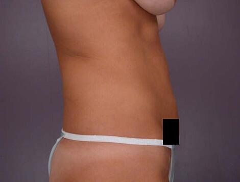 Liposuction Before & After Image