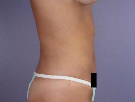 Liposuction Before & After Image