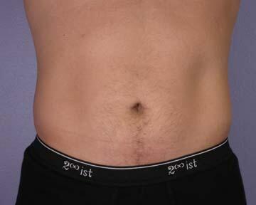 Liposuction Before & After Image