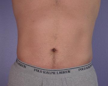 Liposuction Before & After Image