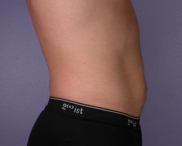 Liposuction Before & After Image