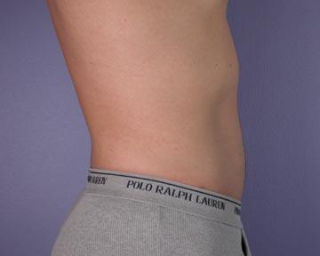 Liposuction Before & After Image