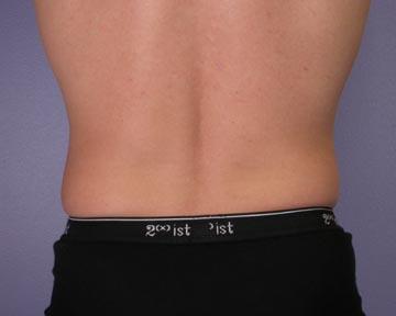 Liposuction Before & After Image