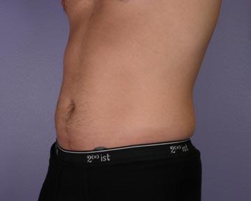 Liposuction Before & After Image