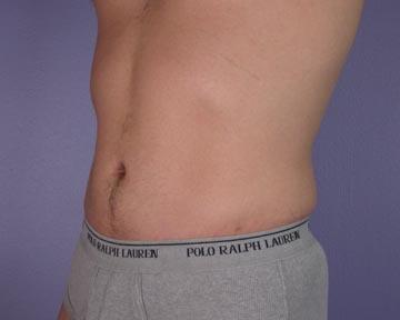 Liposuction Before & After Image