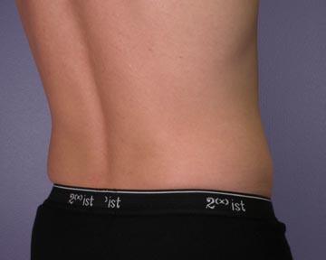 Liposuction Before & After Image