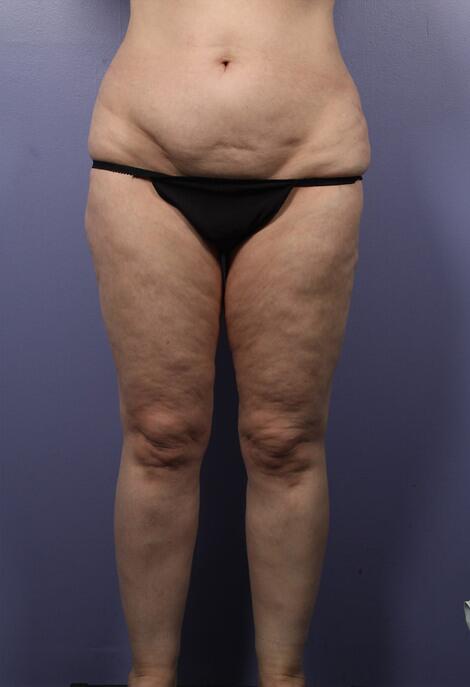 Liposuction Before & After Image