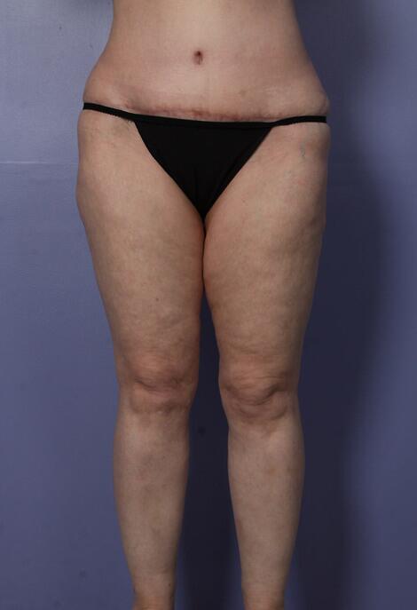 Liposuction Before & After Image