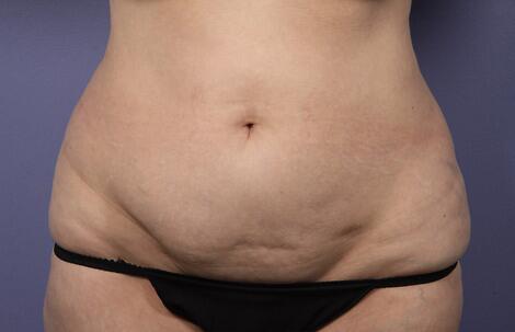 Liposuction Before & After Image