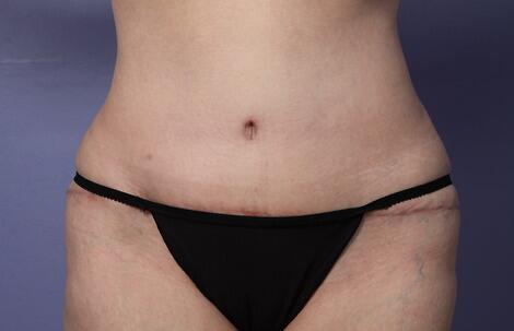 Liposuction Before & After Image