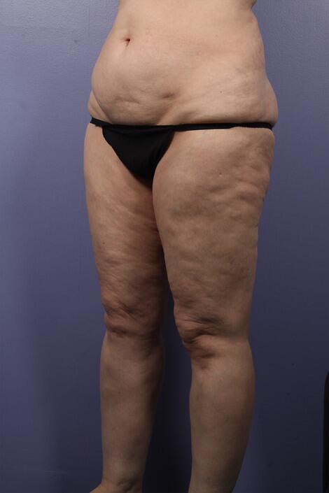 Liposuction Before & After Image