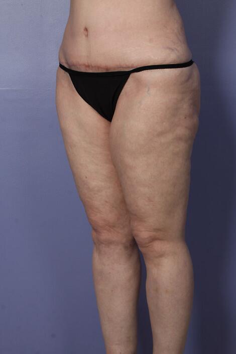 Liposuction Before & After Image