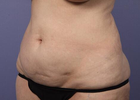 Liposuction Before & After Image