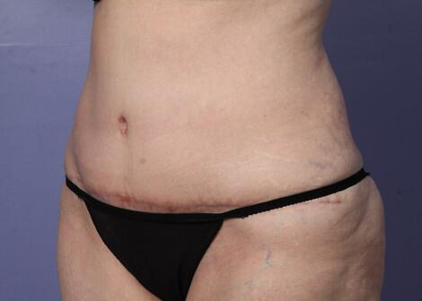 Liposuction Before & After Image