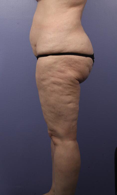 Liposuction Before & After Image