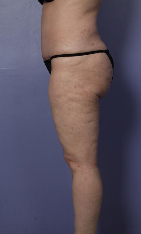 Liposuction Before & After Image