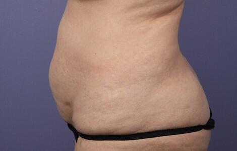 Liposuction Before & After Image