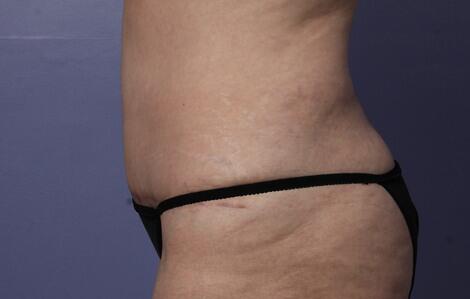 Liposuction Before & After Image