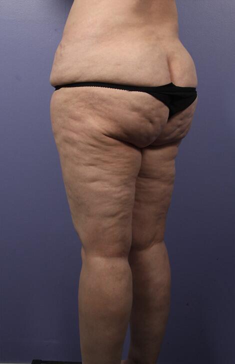 Liposuction Before & After Image