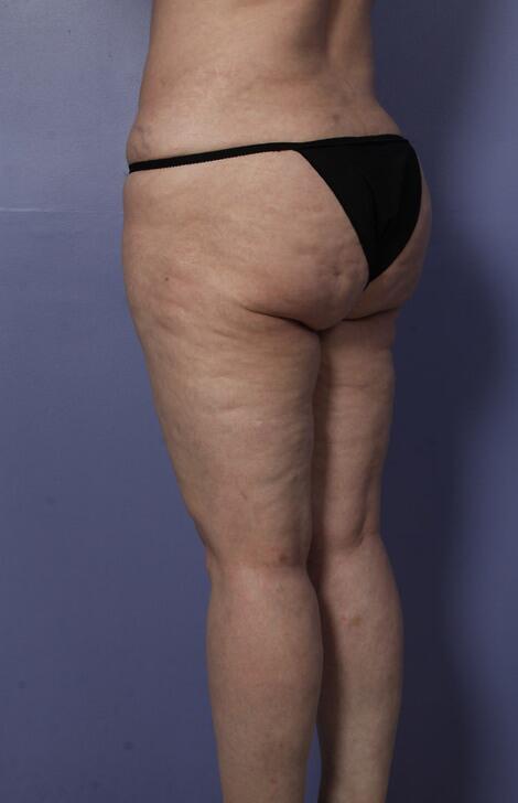 Liposuction Before & After Image