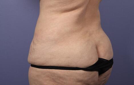 Liposuction Before & After Image