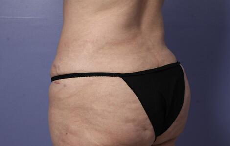 Liposuction Before & After Image