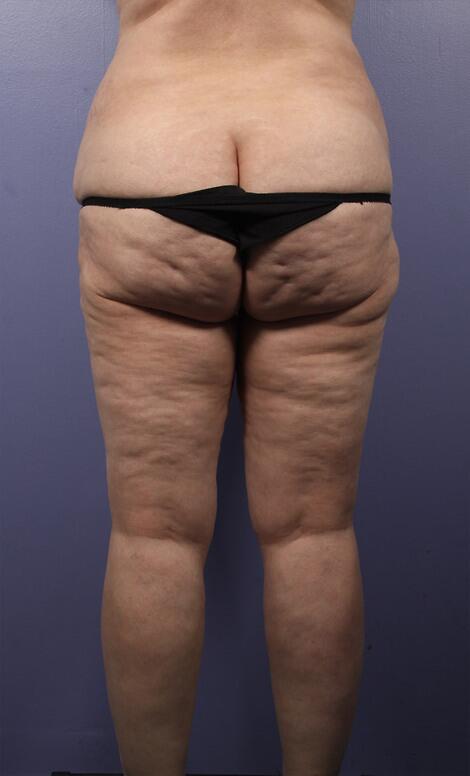 Liposuction Before & After Image