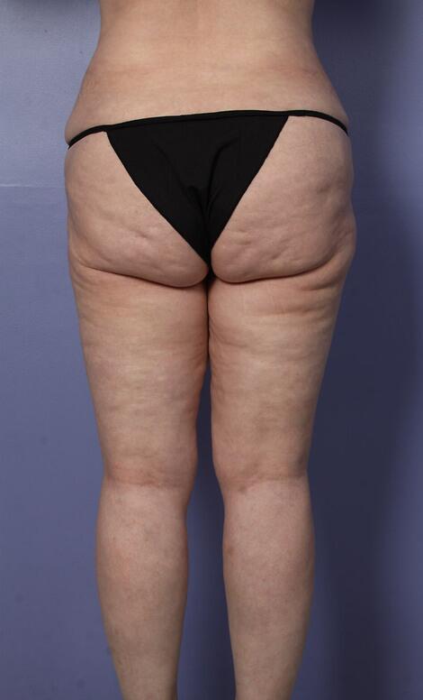 Liposuction Before & After Image