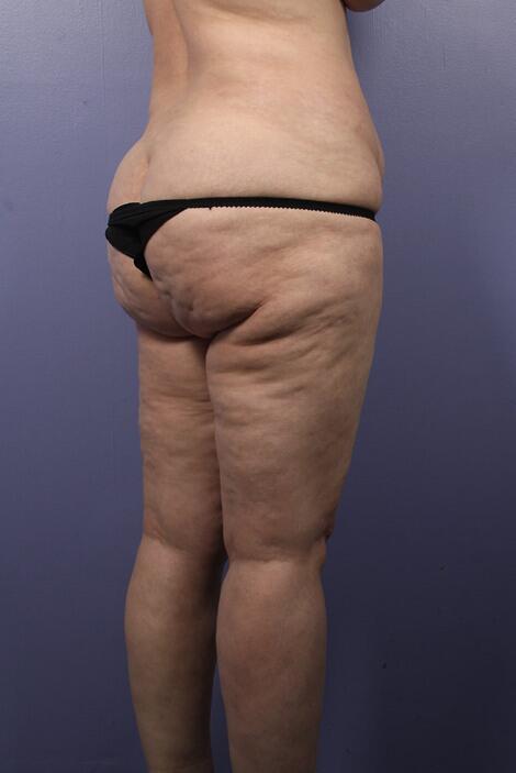 Liposuction Before & After Image