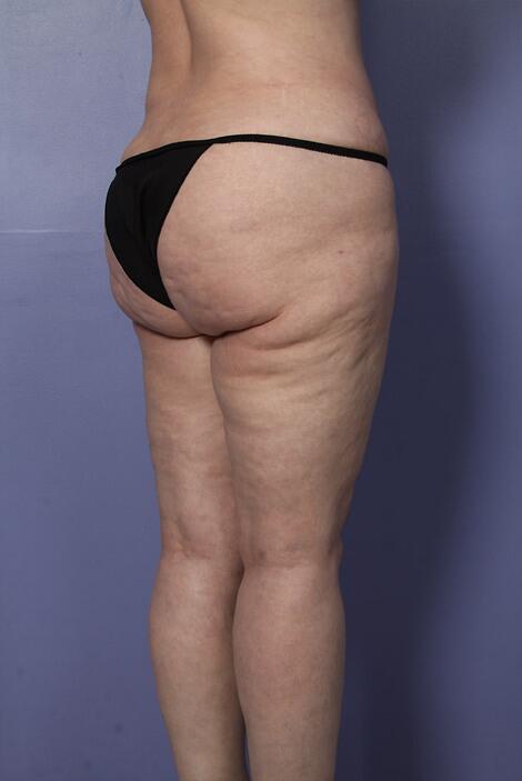 Liposuction Before & After Image