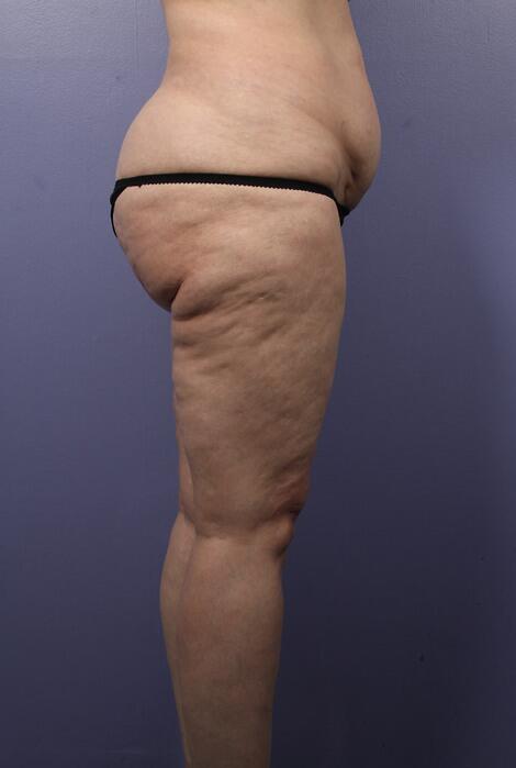 Liposuction Before & After Image