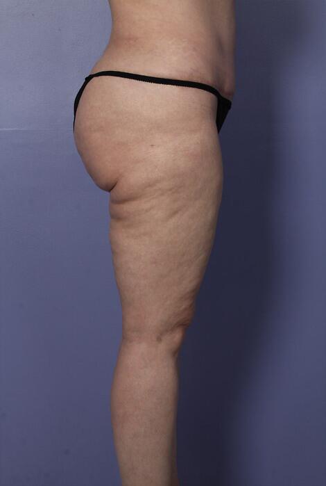 Liposuction Before & After Image