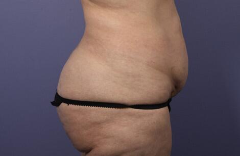 Liposuction Before & After Image