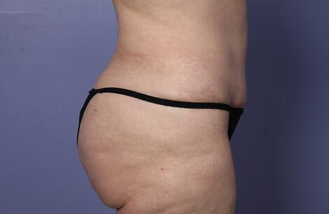 Liposuction Before & After Image