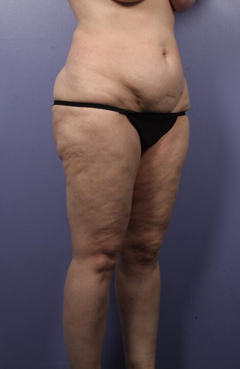 Liposuction Before & After Image