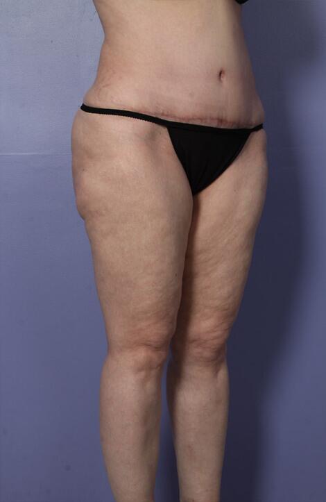 Liposuction Before & After Image