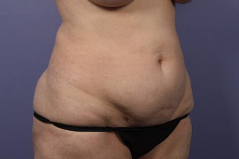 Liposuction Before & After Image