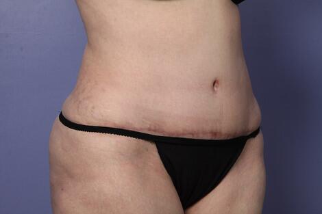 Liposuction Before & After Image