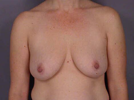 Liposuction Before & After Image