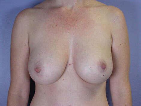 Liposuction Before & After Image