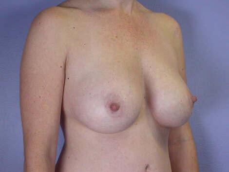 Liposuction Before & After Image