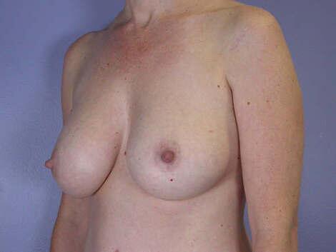 Liposuction Before & After Image