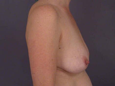 Liposuction Before & After Image