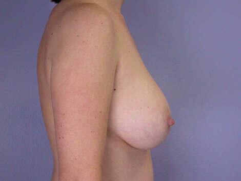 Liposuction Before & After Image