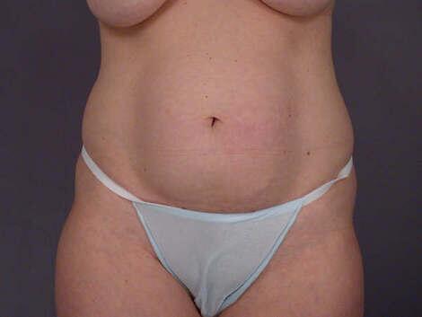 Liposuction Before & After Image