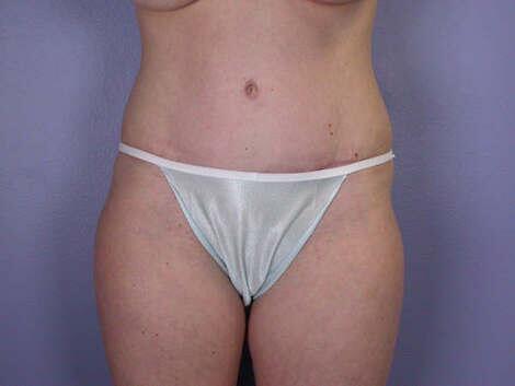 Liposuction Before & After Image