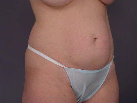 Liposuction Before & After Image